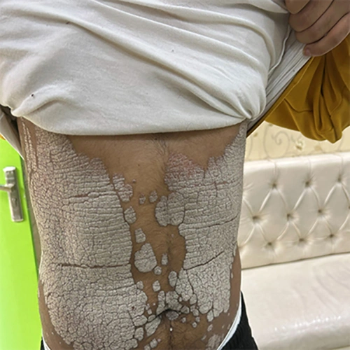 علاج أمراض الجلد في الهند | أفضل طبيب ومستشفى