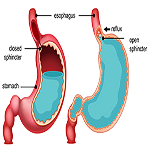 علاج أمراض الجهاز الهضمى في الهند | رعاية متخصصة