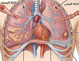 علاج أمراض الرئة والصدر في الهند