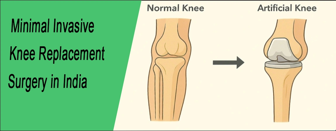 Knee Replacement Surgery in India | Top Surgeons & Hospitals