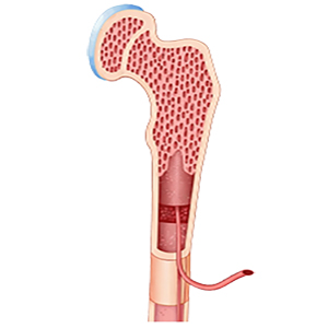 Bone Marrow Transplant in India - Cost, Hospitals & Success Rates